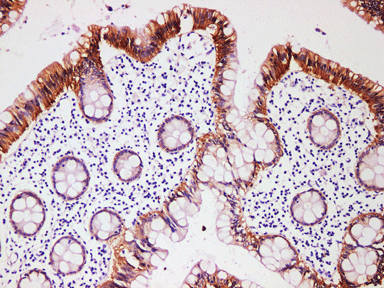 β-Catenin 结肠癌